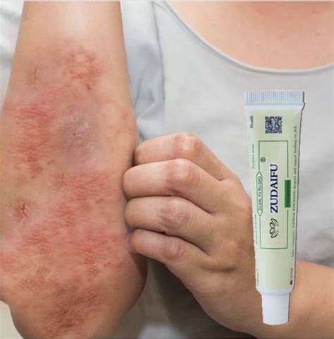 Say Goodbye to Steroids: How the Magic Eczema Cream Offers a Safer and Gentler Solution
